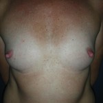 Pre op breast augmentation