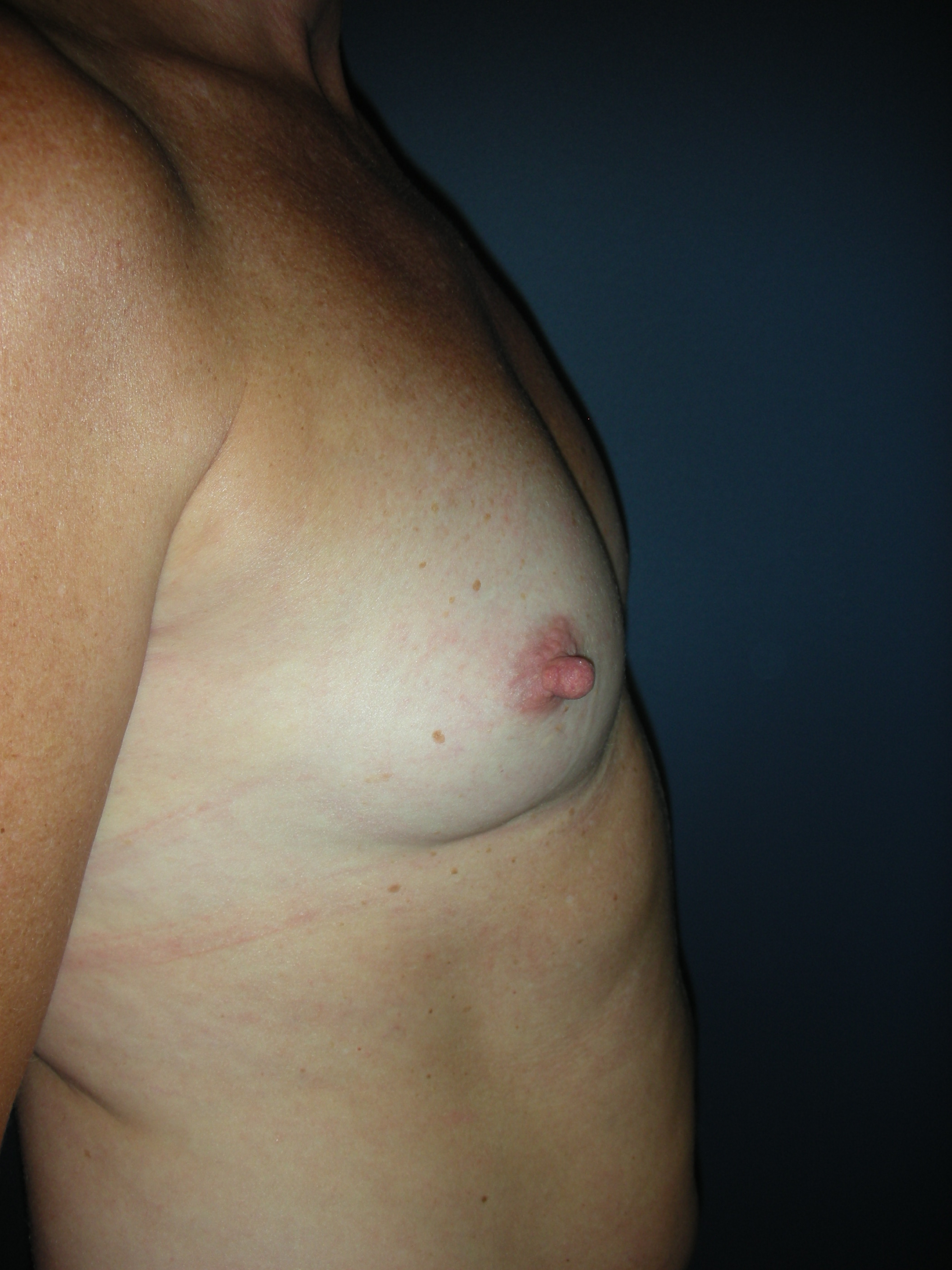 Pre op breast augmentation
