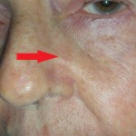Image of Skin cancer left nose before surgery
