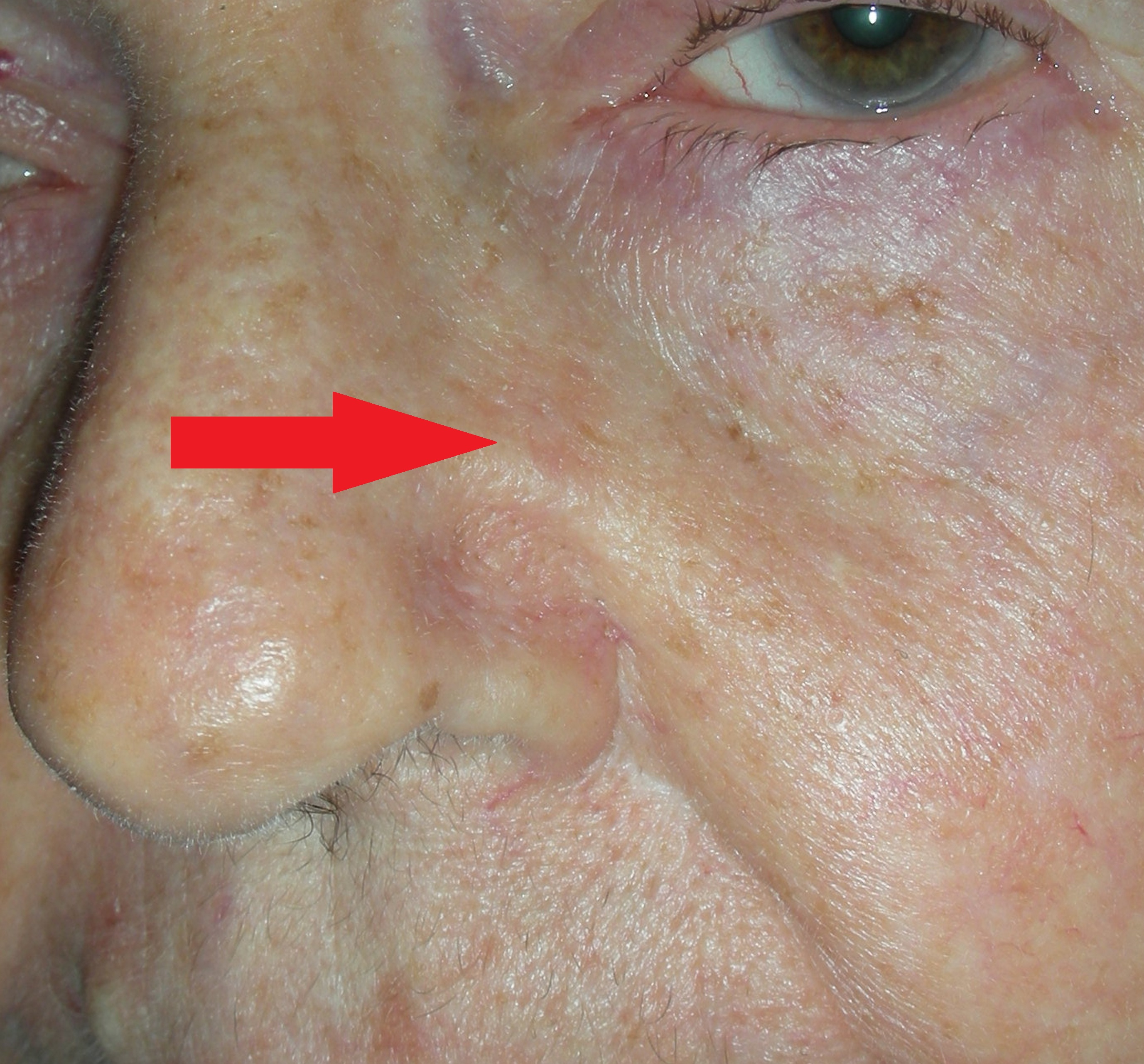 Image of Skin cancer left nose before surgery