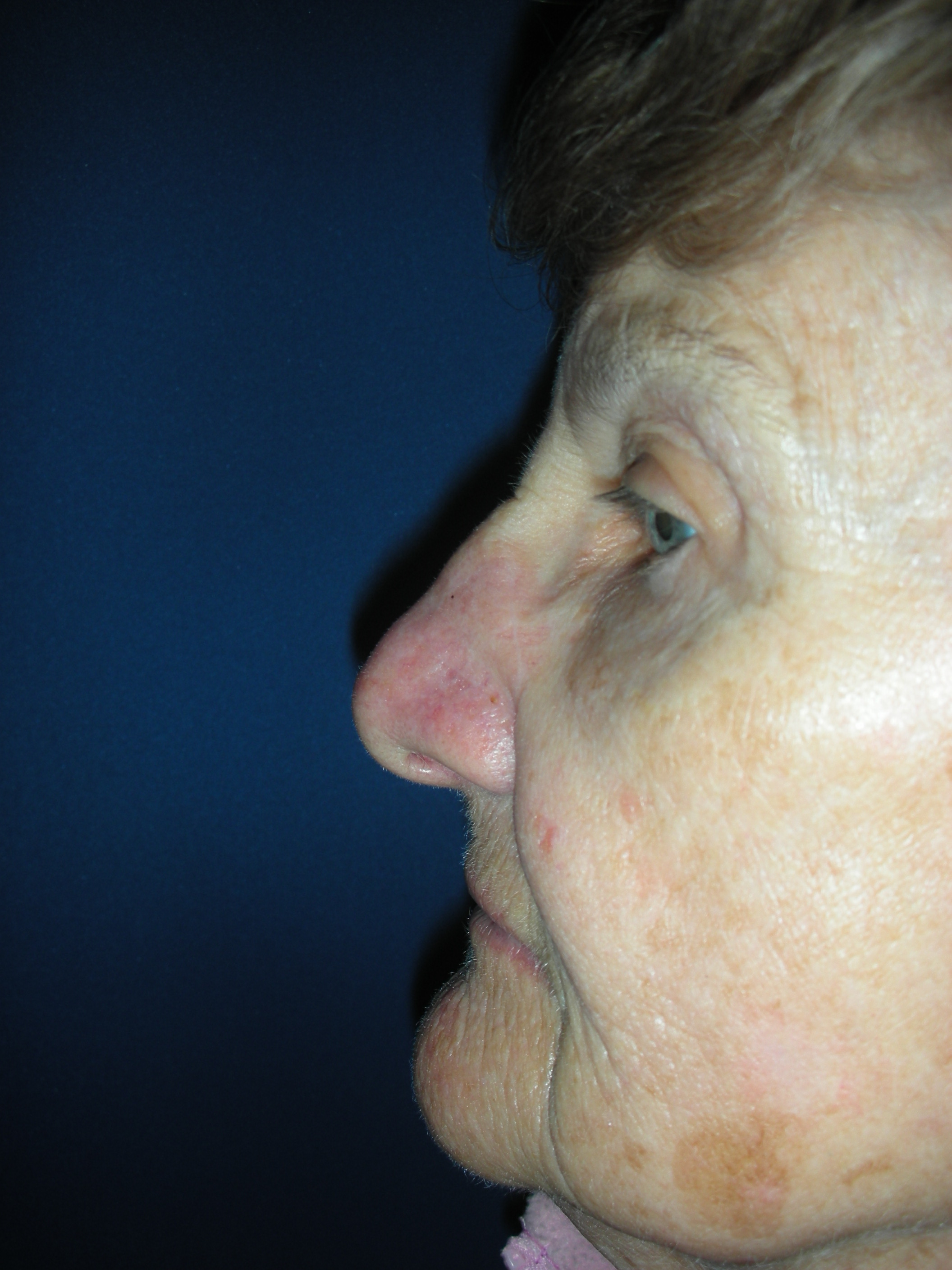 Image of flap reconstruction of nose