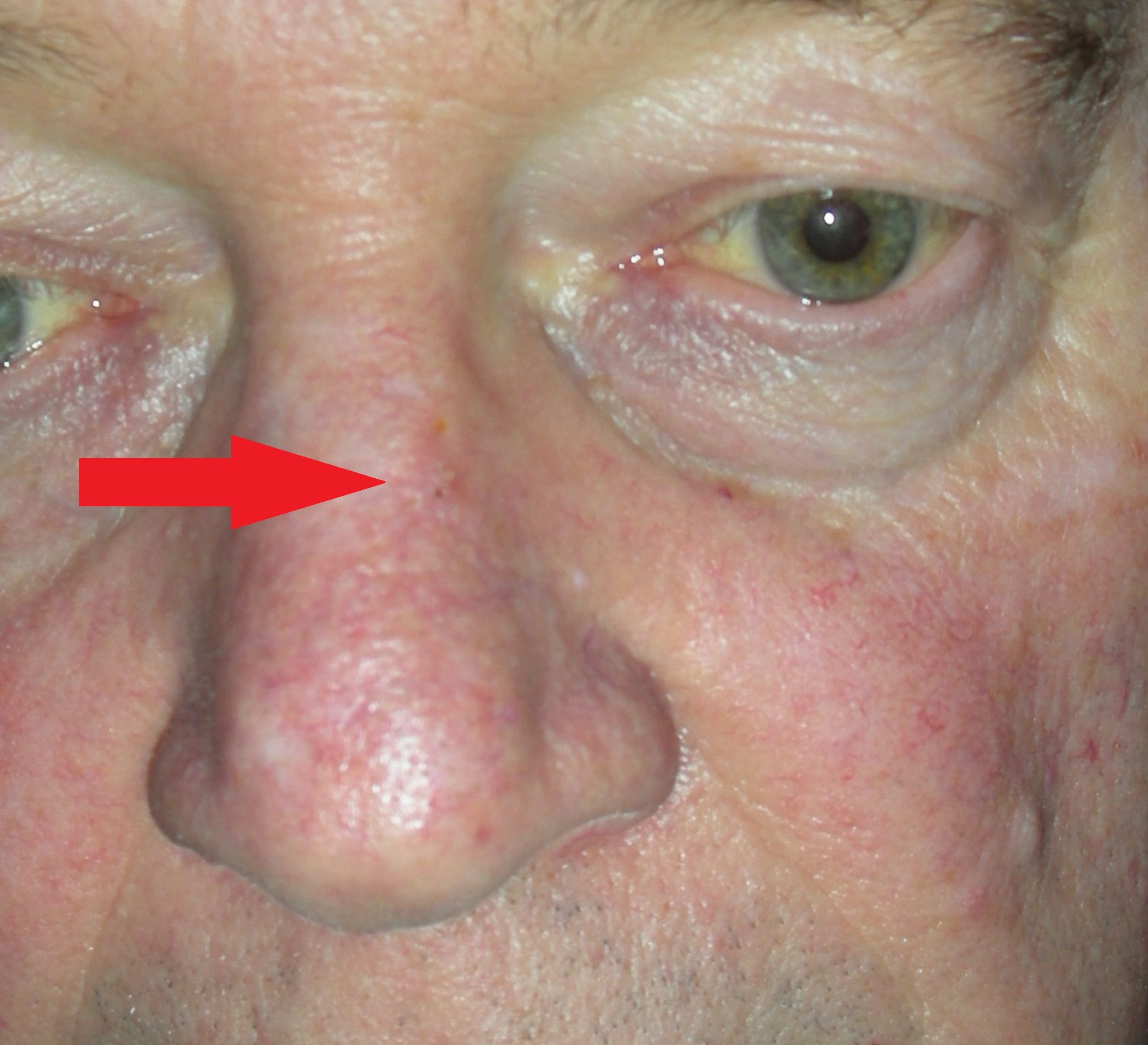 Image of skin cancer left nose