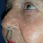 Image of Reconstructed nose after skin cancer removal
