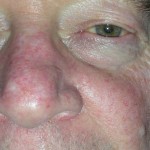 Image of skin cancer nose after flap repair