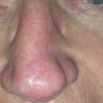 Image of Nose after reconstructive surgery