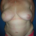 Post op immediate right breast reconstruction