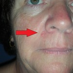 Skin cancer upper lip before surgery