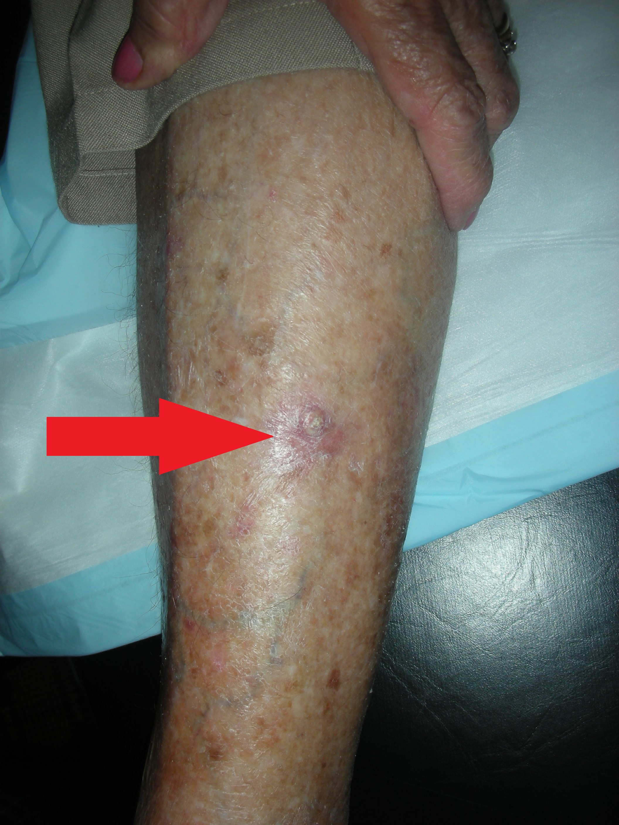 Skin cancer leg