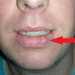 Skin cancer lower lip