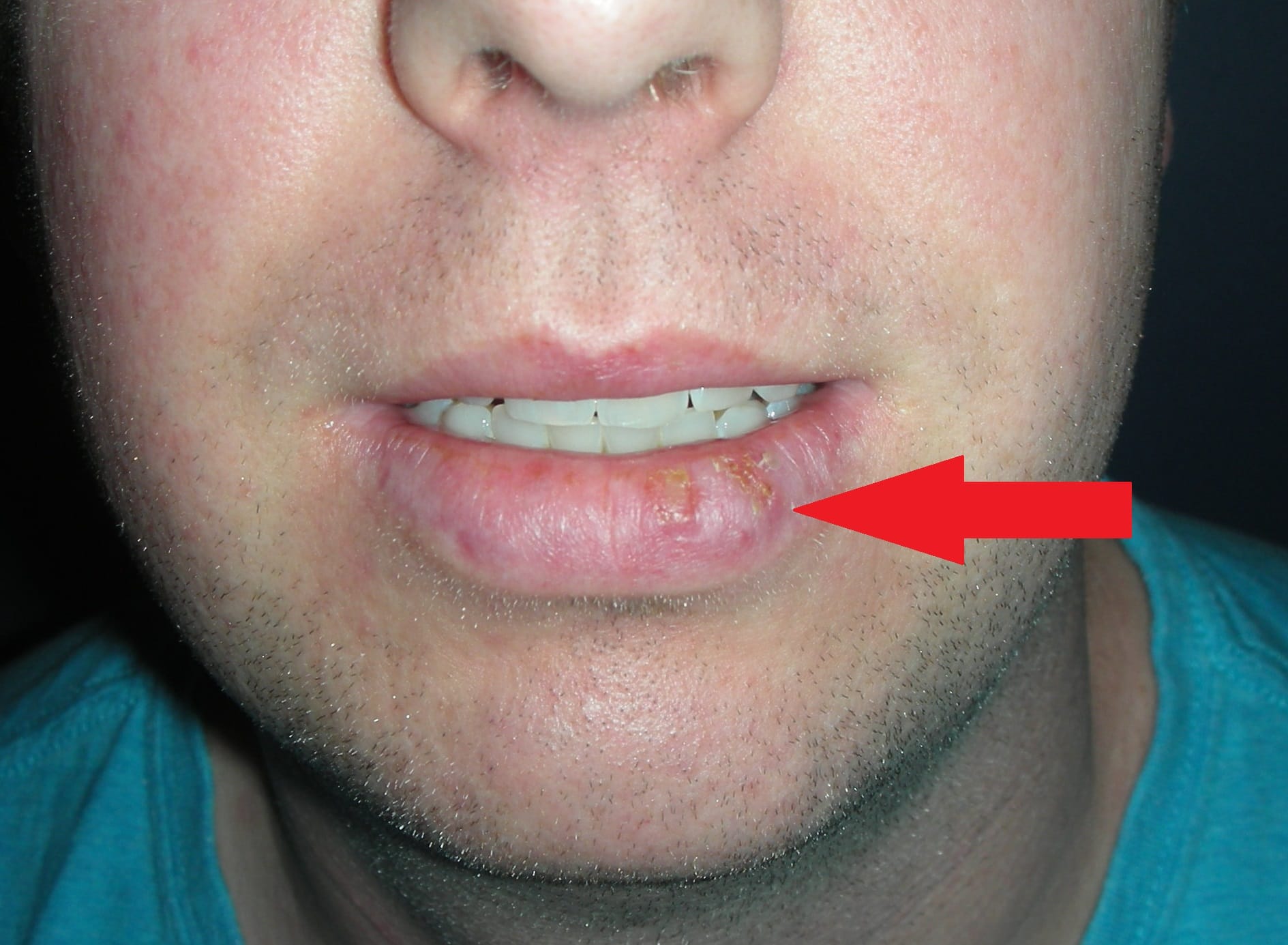 Skin cancer lower lip