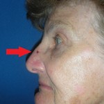 Image of a skin cancer on the nose