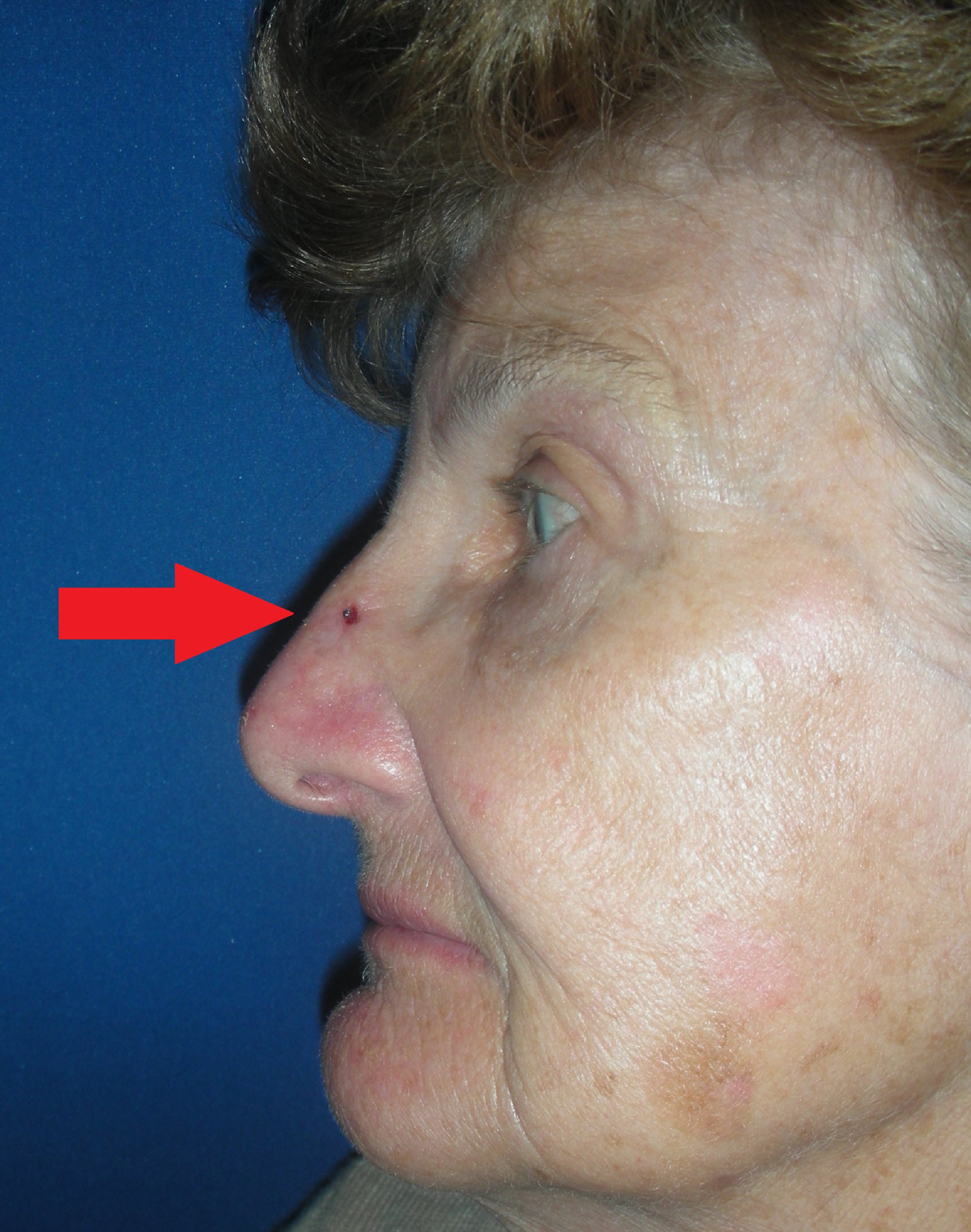 Image of a skin cancer on the nose