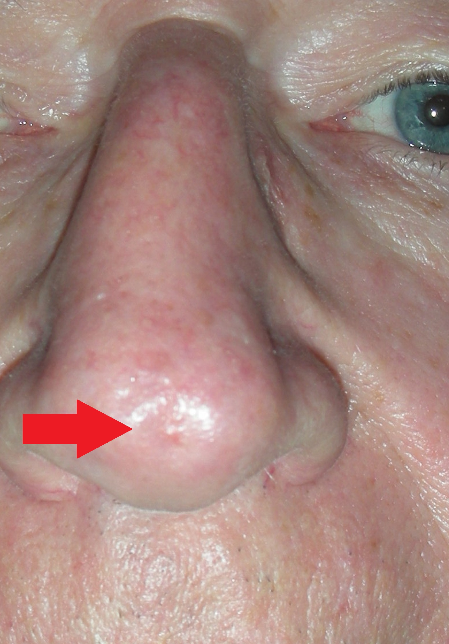 Image of skin cancer tip of nose