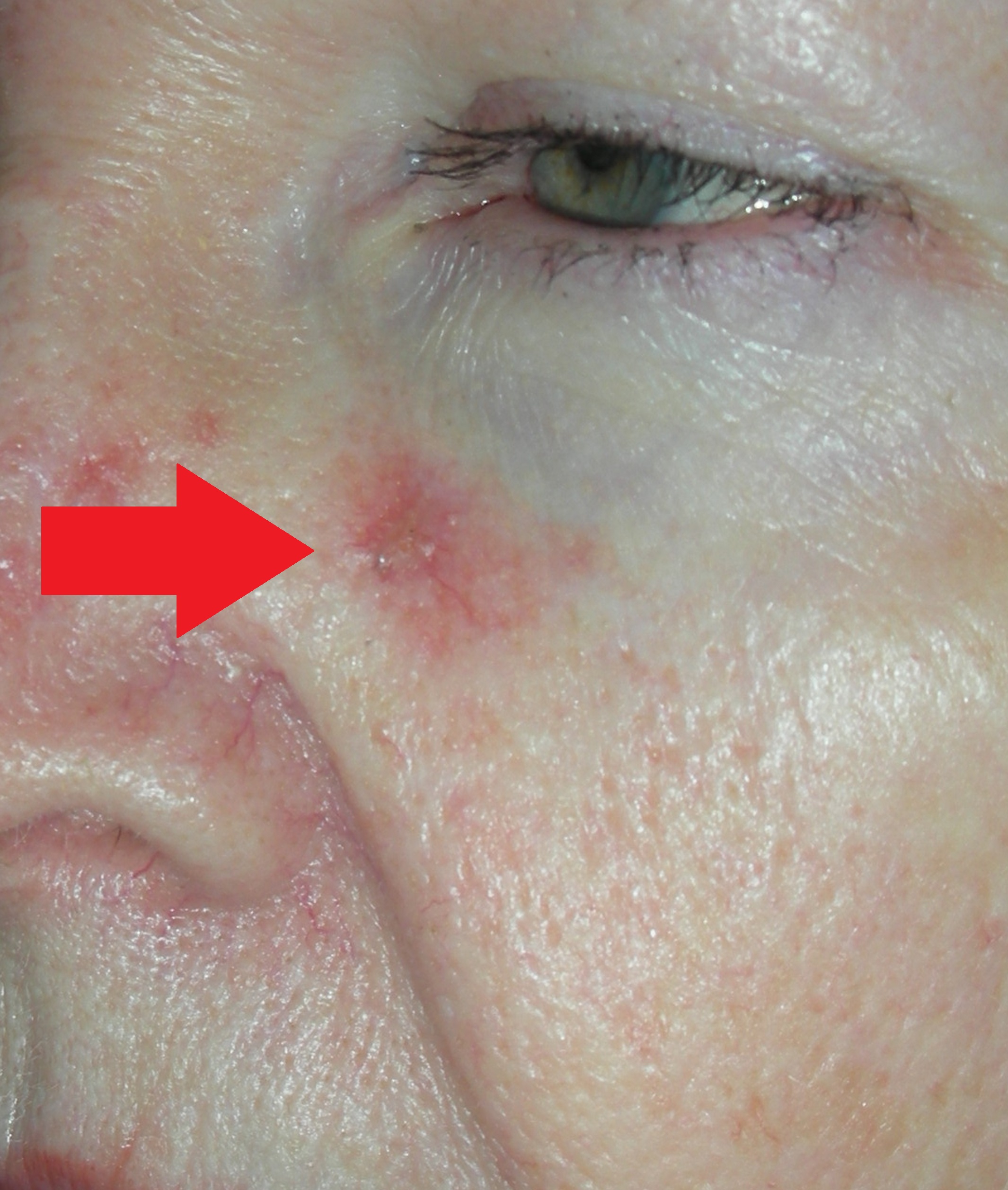 Image of skin cancer left nose