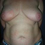 Pre op right mastectomy and reconstruction