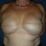 Bilateral breast reconstruction with implants