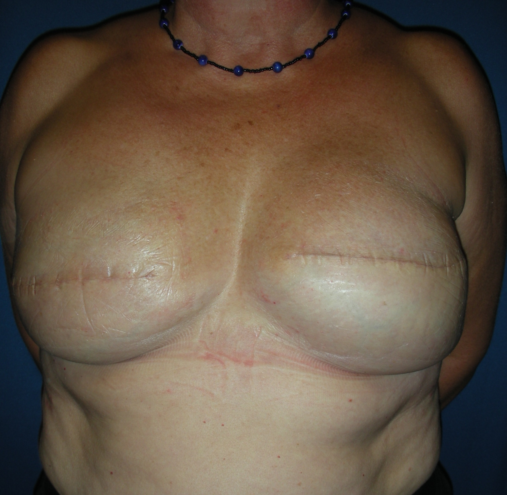 Bilateral breast reconstruction with implants