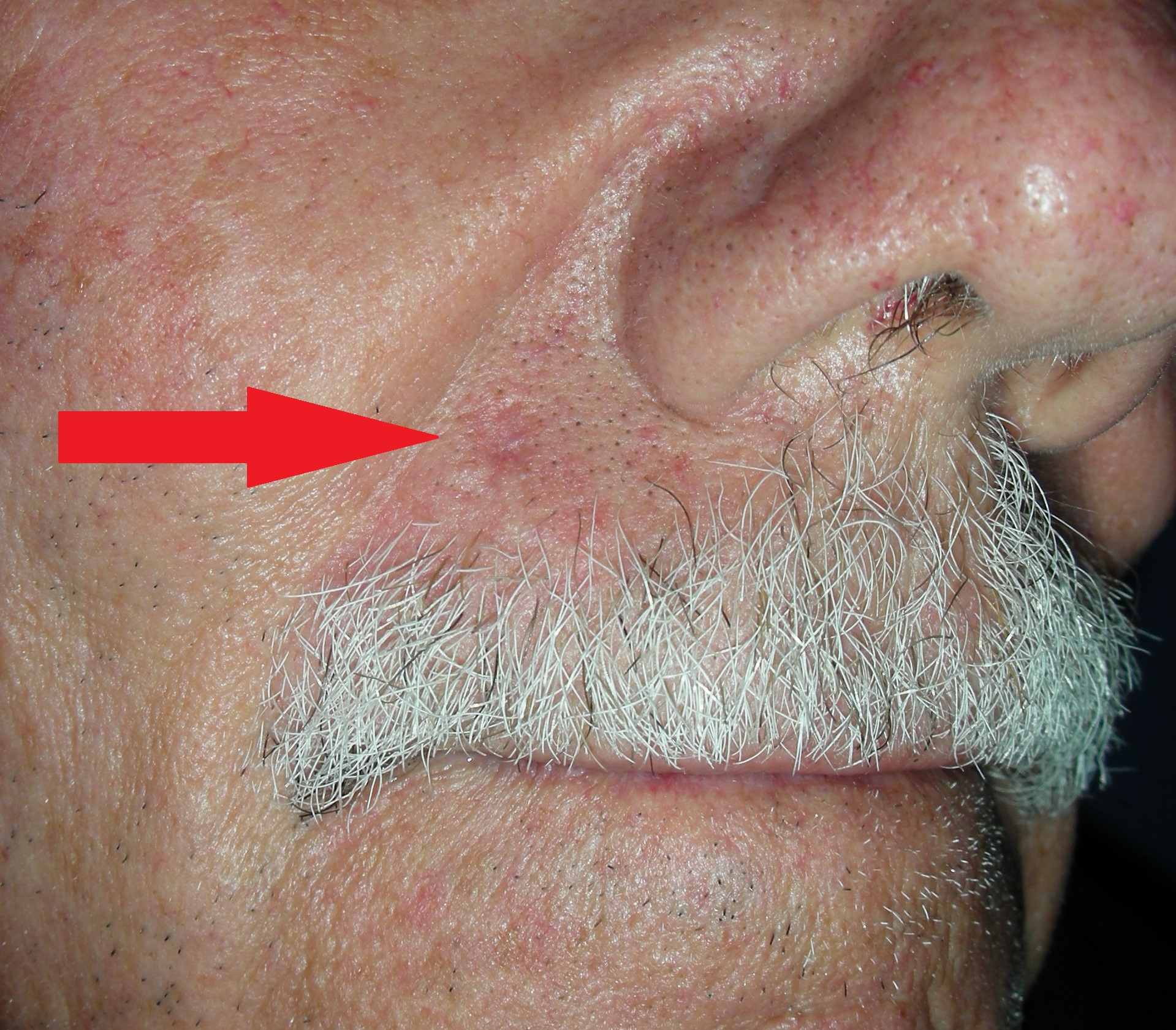 Image of skin cancer upper lip