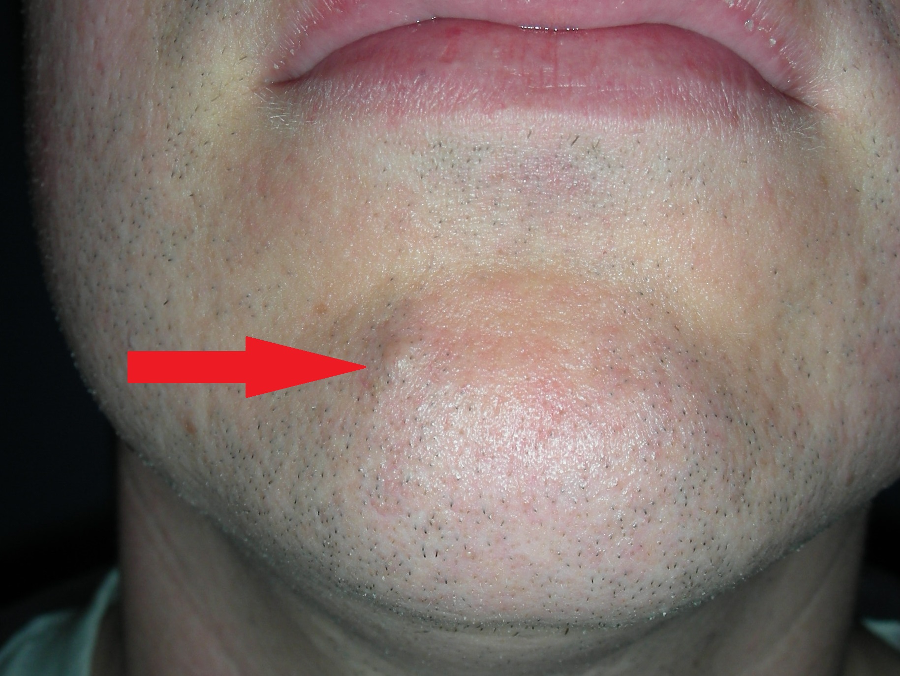 Mole lower lip