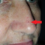 Skin cancer Nose