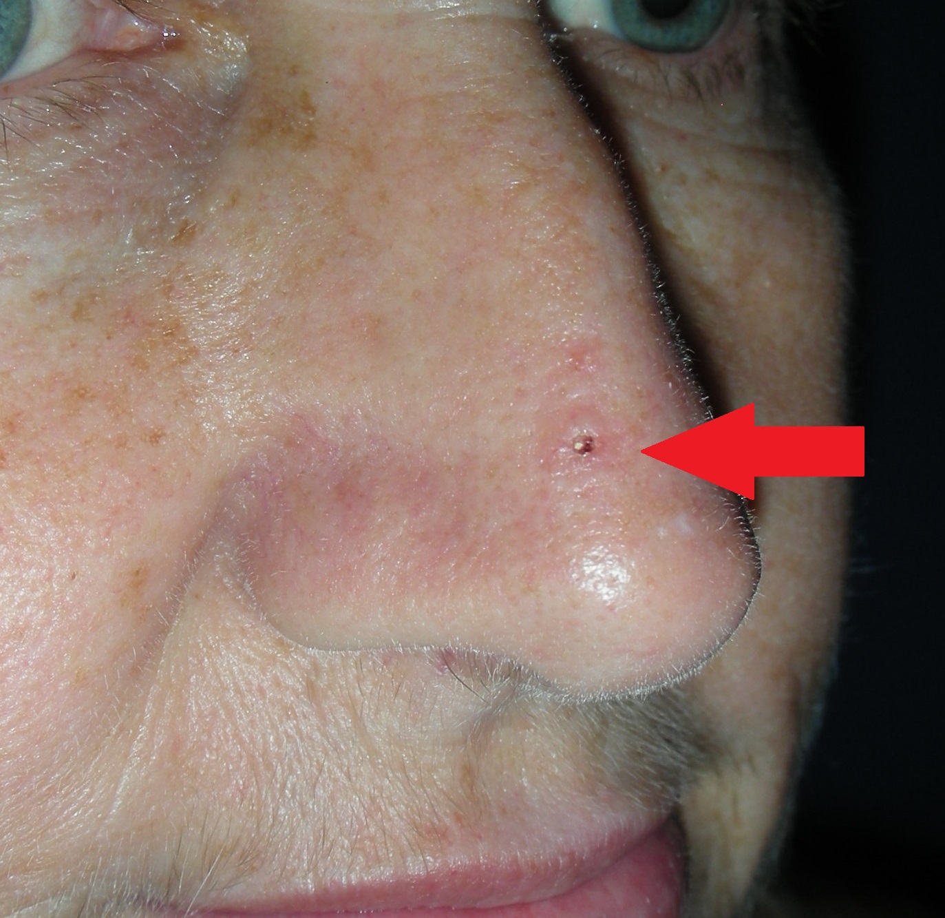 Skin cancer Nose