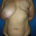 Pre op breast reconstruction