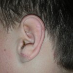 Correction of stretched earlobes