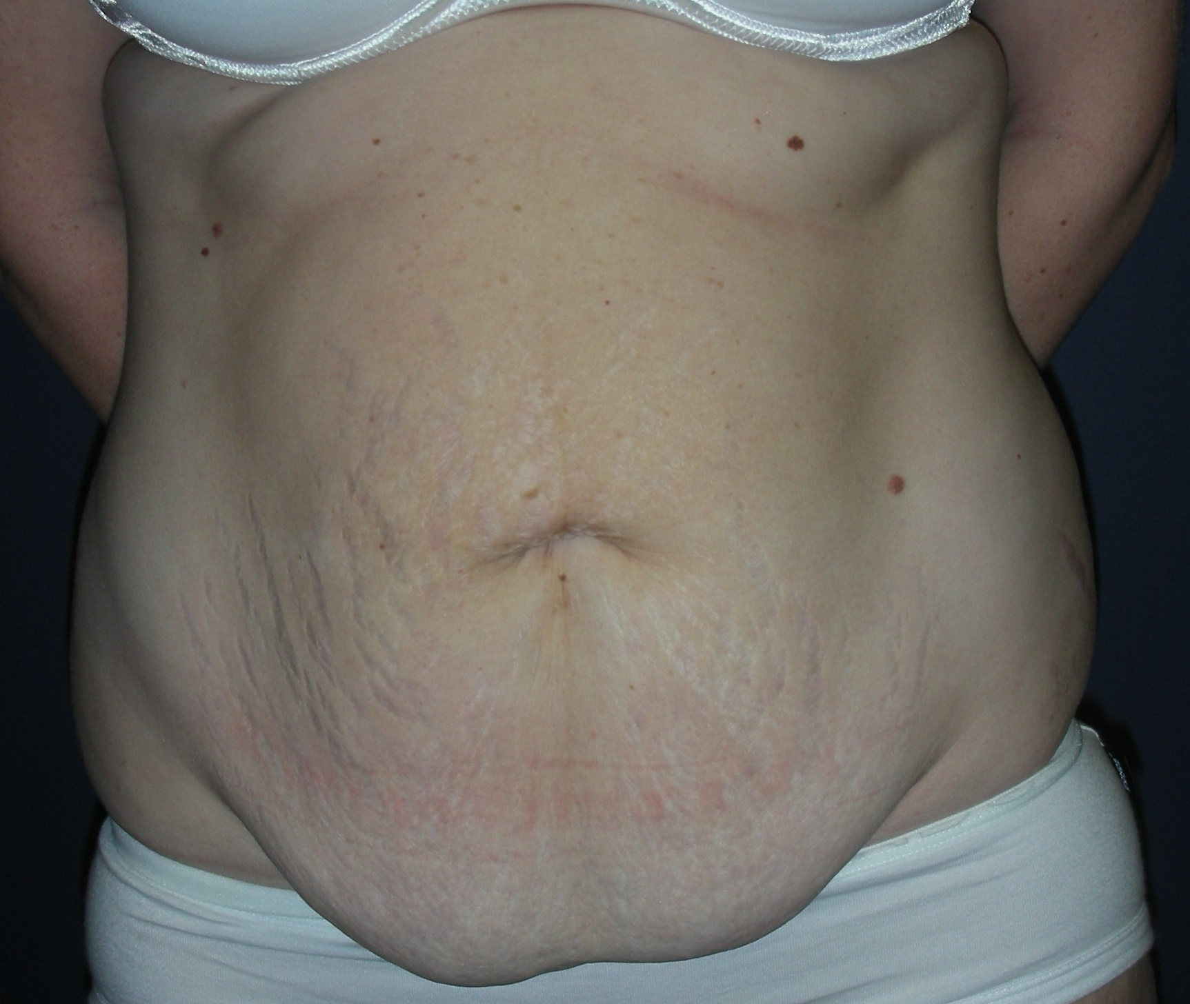 Pre surgery abdomen