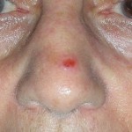 Skin cancer nose