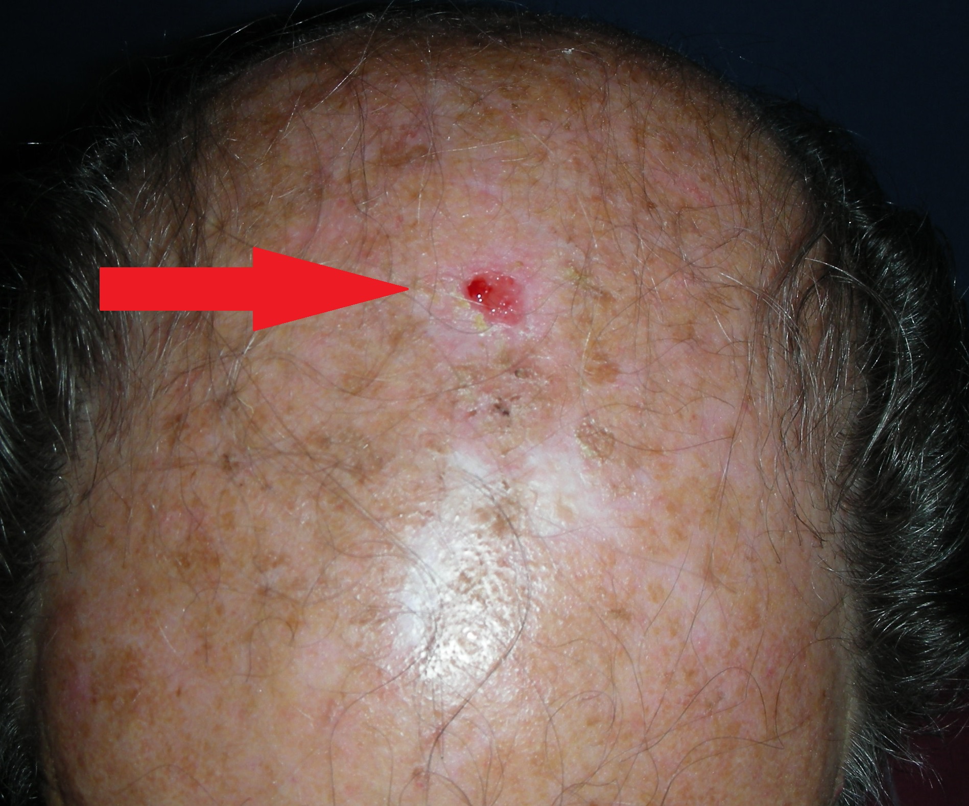 Skin cancer scalp