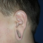 Stretched earlobe