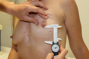 Nipple to Infra Mammary Fold (N:IMF) measurement