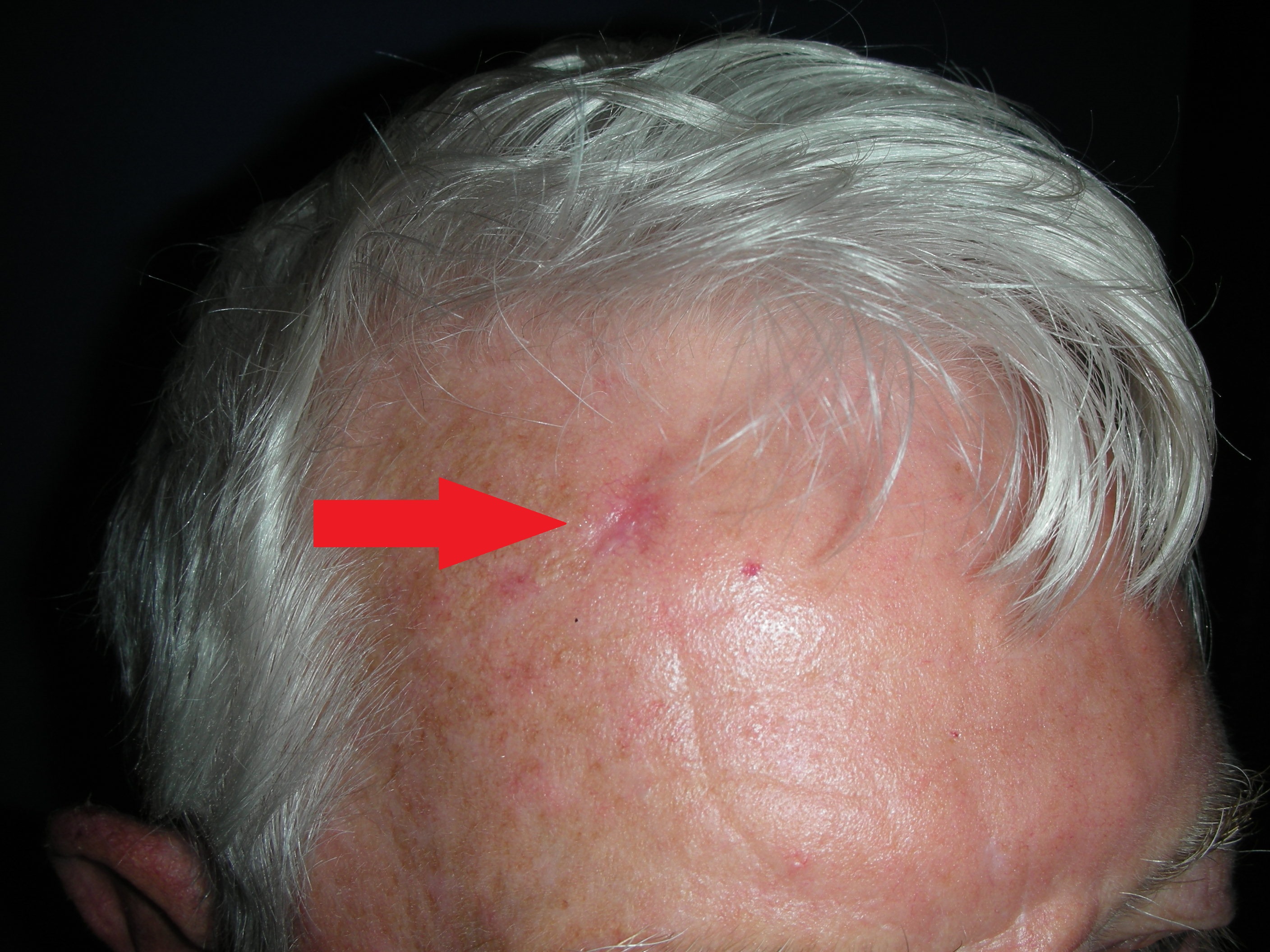 Skin cancer right forehead