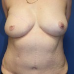 Right free TRAM flap and left breast reduction