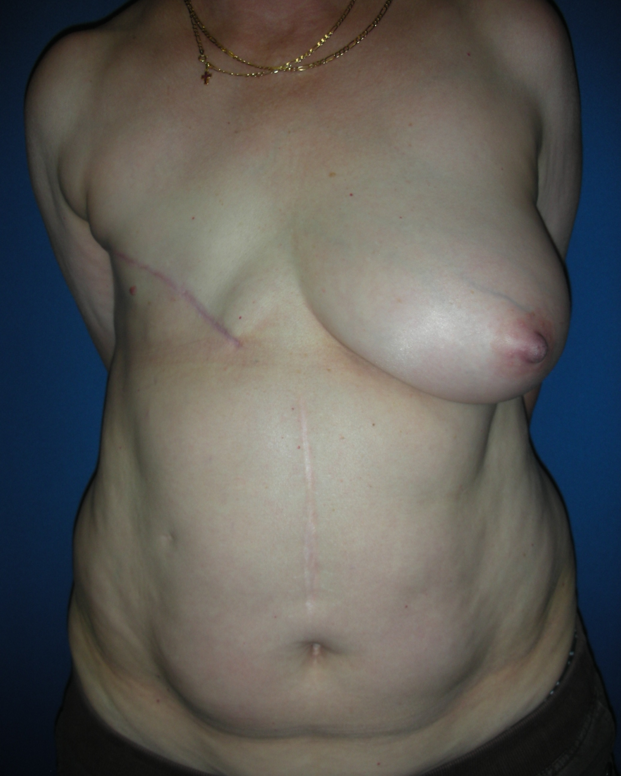 Right mastectomy for cancer