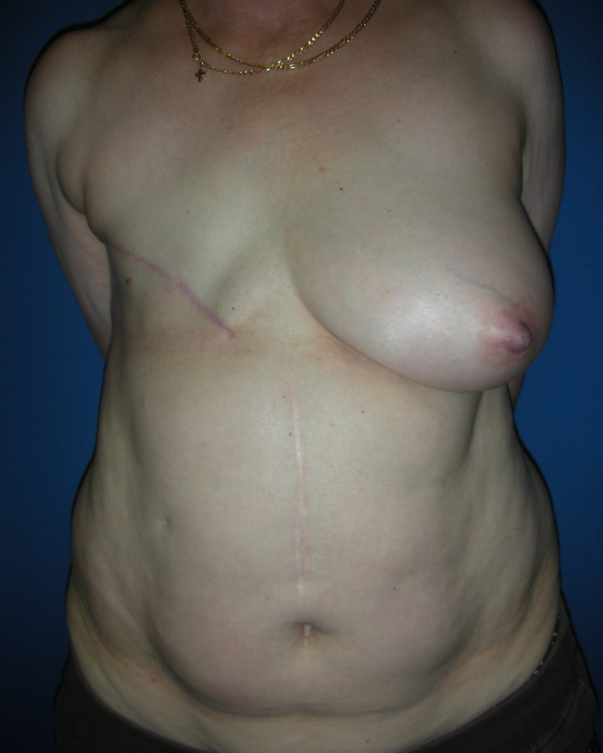 Mastectomy Porn