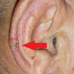 Skin cancer ear