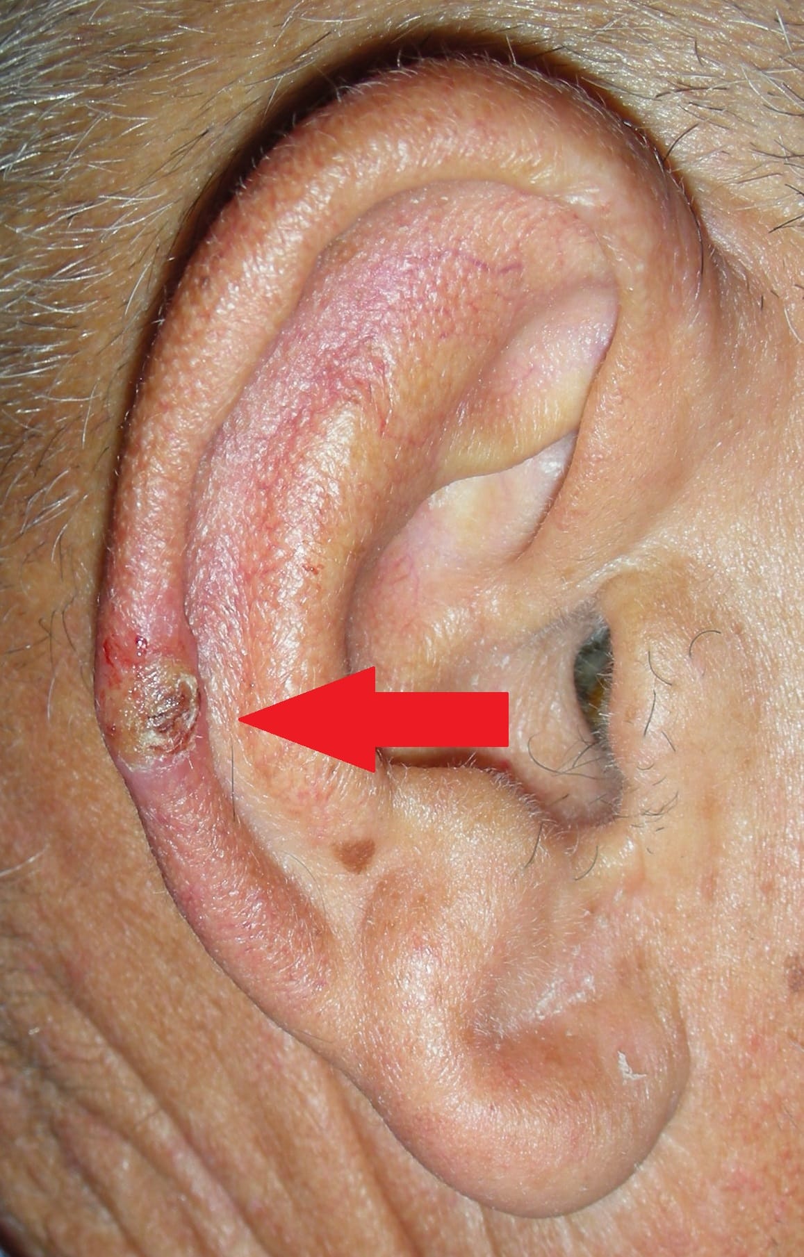 Skin cancer ear