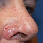 Skin graft nose