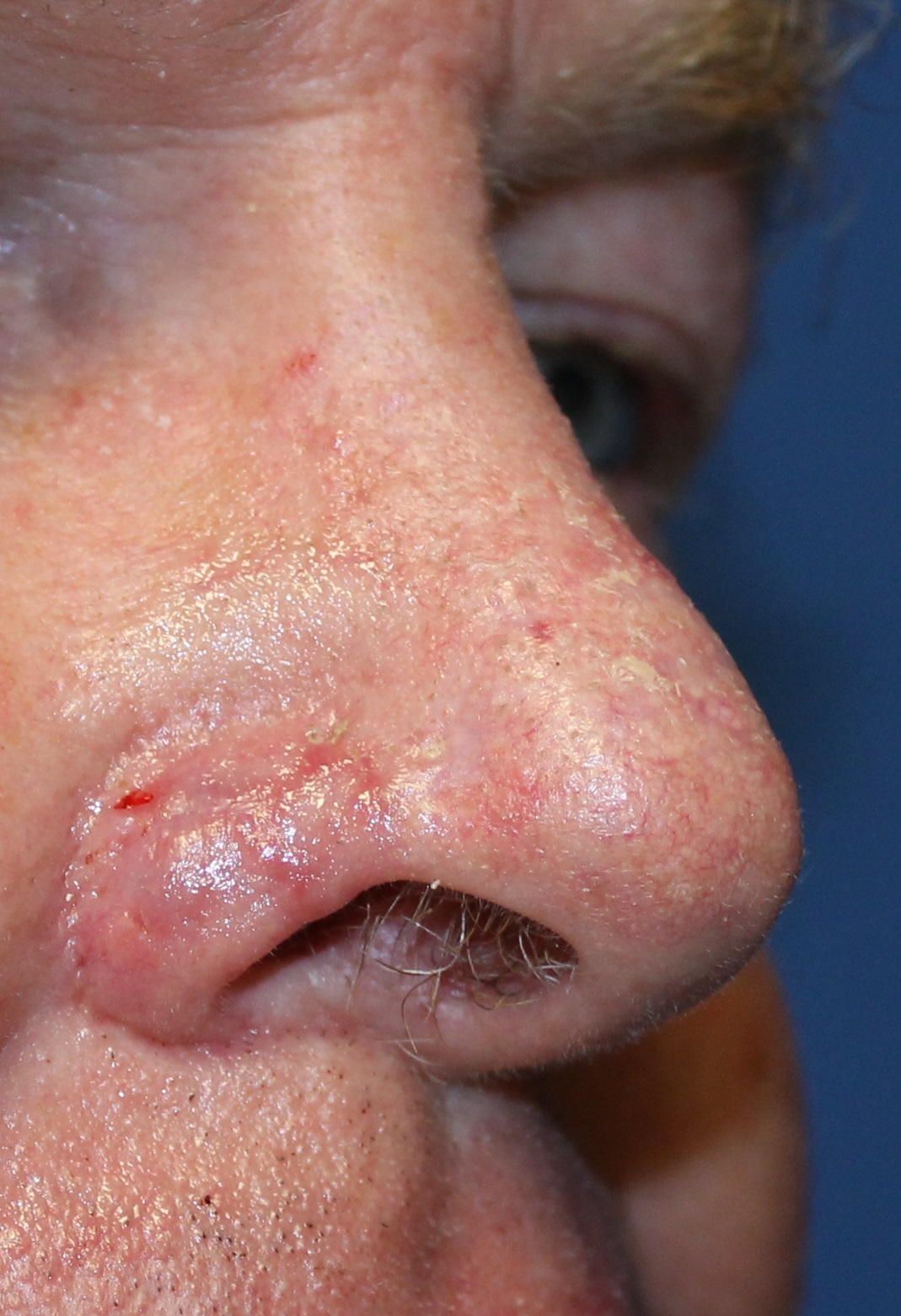 Skin graft nose