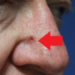 Skin cancer nose
