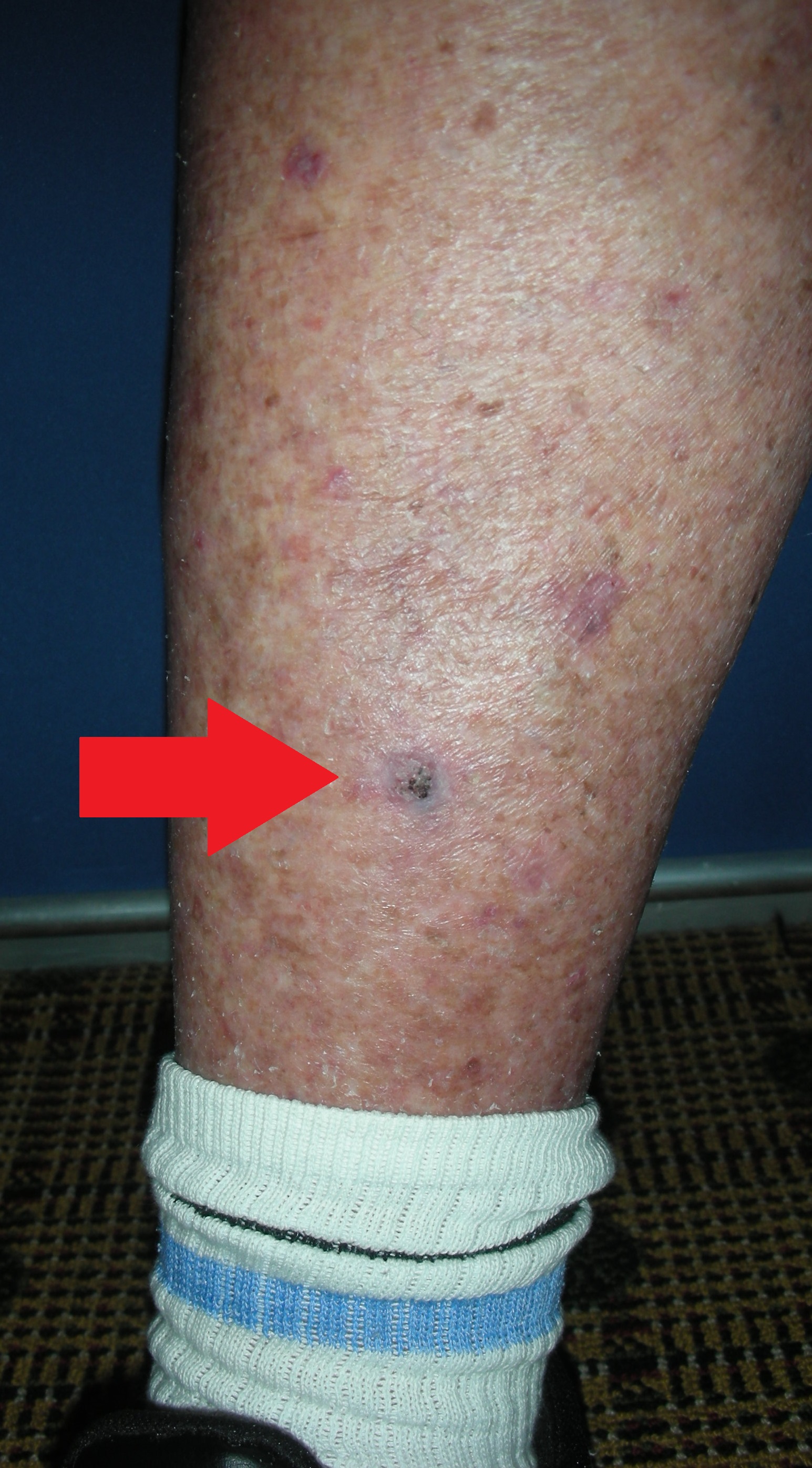 Skin cancer leg