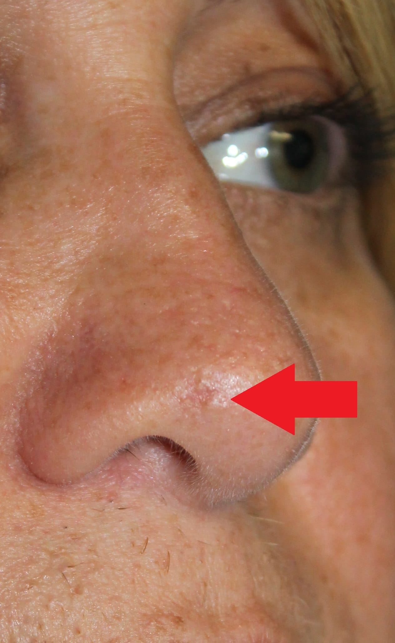 Skin cancer nose