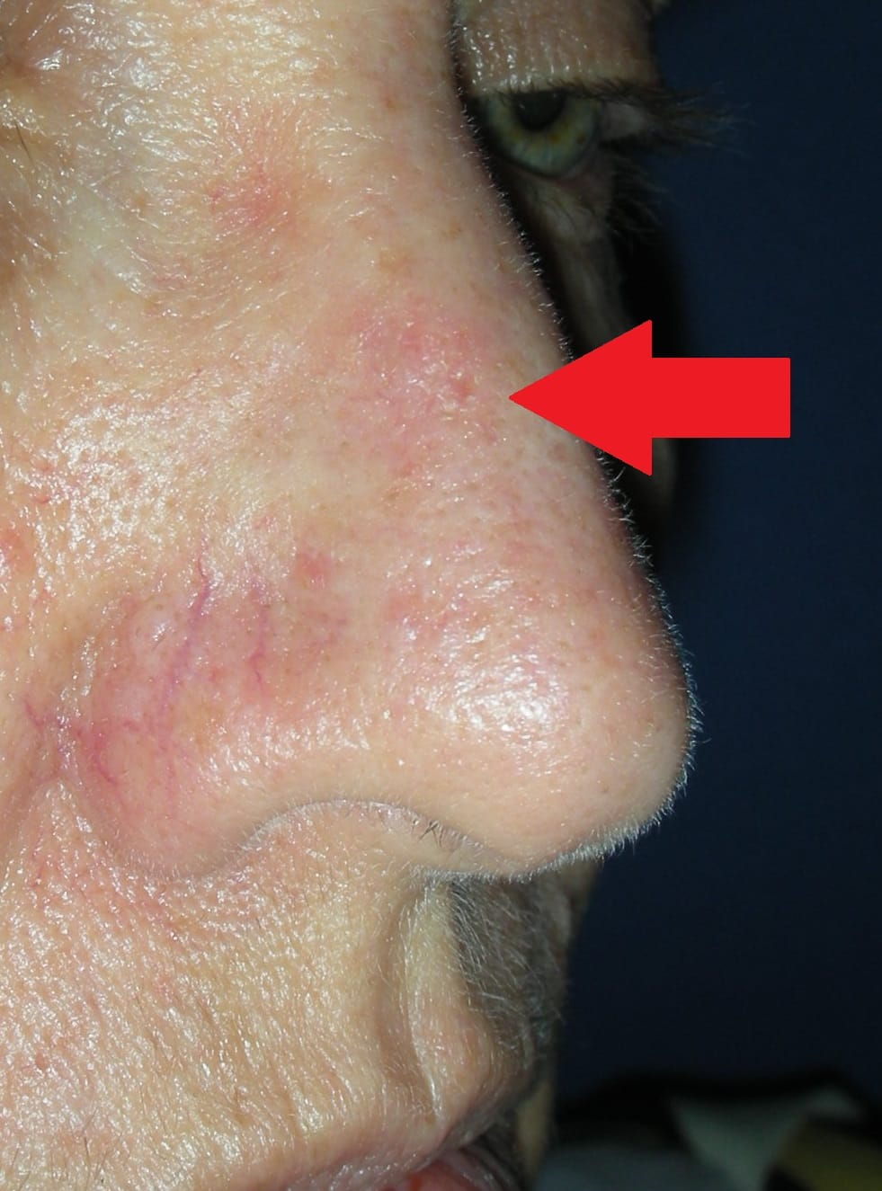 Skin cancer nose