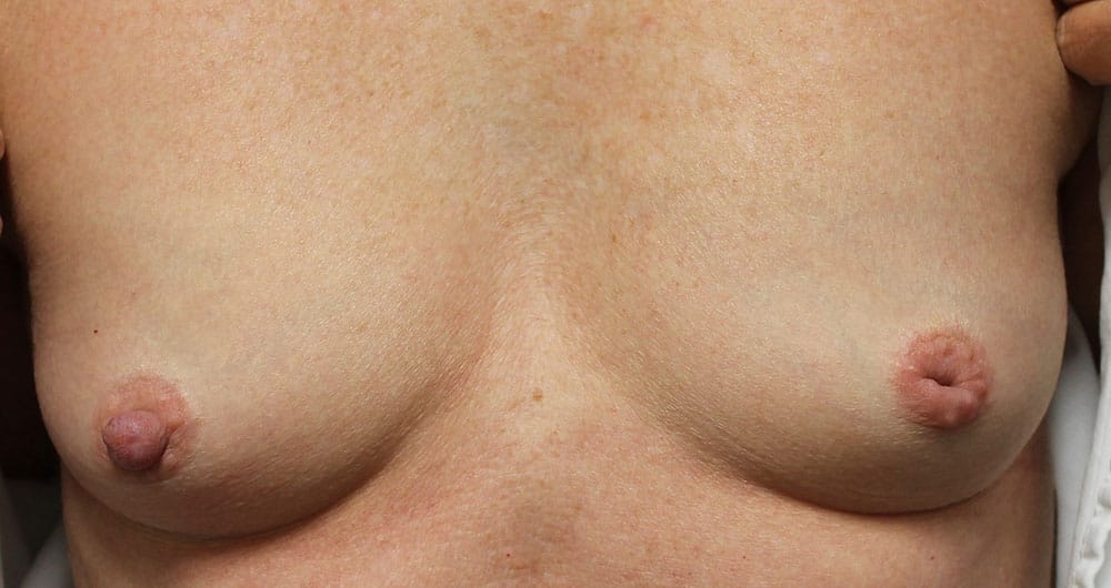 Breast implants with inverted nipples