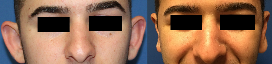 Prominent Ear Correction Otoplasty Surgery A Prof Damian Marucci cosmetic plastic reconstructive surgeon