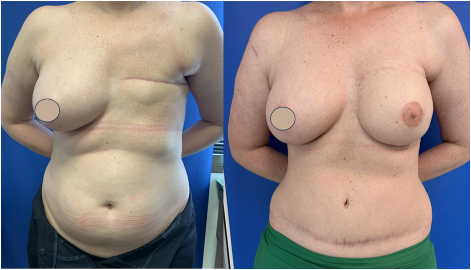 https://www.drdamianmarucci.com.au/wp-content/uploads/2023/12/Breast-Reconstruction-with-DIEP-Flap.png
