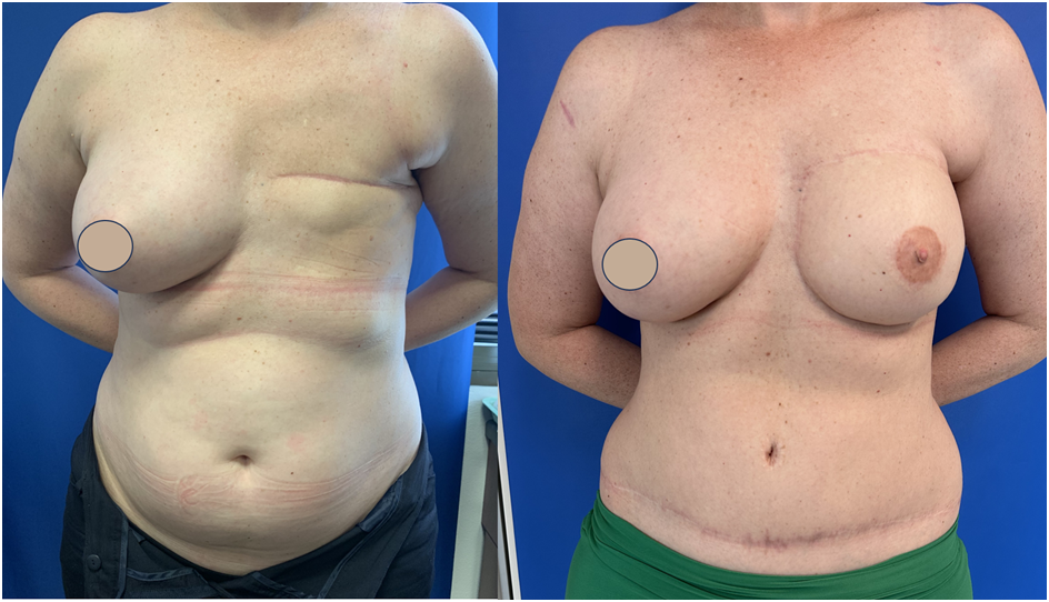 Breast Reconstruction with DIEP Flap - A/Prof Damian Marucci