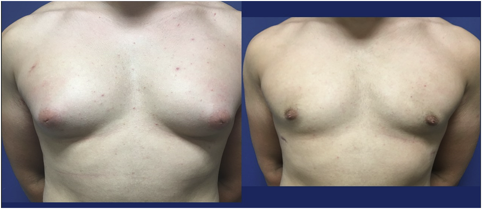 Breast Reconstruction with DIEP Flap - A/Prof Damian Marucci cosmetic  plastic reconstructive surgeon